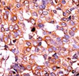 Formalin-fixed and paraffin-embedded human cancer tissue reacted with the primary antibody, which was peroxidase-conjugated to the secondary antibody, followed by DAB staining. This data demonstrates the use of this antibody for immunohistochemistry; clinical relevance has not been evaluated. BC = breast carcinoma; HC = hepatocarcinoma.