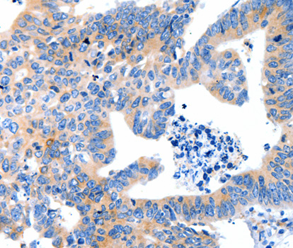 Immunohistochemistry of paraffin-embedded human colon cancer tissue using LRPAP1 antibody.