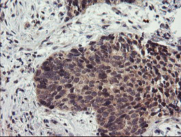 IHC of paraffin-embedded Carcinoma of Human lung tissue using anti-LRRC25 mouse monoclonal antibody.