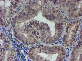 IHC of paraffin-embedded Adenocarcinoma of Human endometrium tissue using anti-LRRC25 mouse monoclonal antibody.