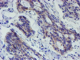 IHC of paraffin-embedded Carcinoma of Human pancreas tissue using anti-LRRC25 mouse monoclonal antibody.