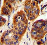 LRRC57 Antibody immunohistochemistry of formalin-fixed and paraffin-embedded human bladder carcinoma followed by peroxidase-conjugated secondary antibody and DAB staining.