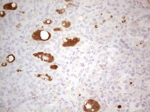 IHC of paraffin-embedded Carcinoma of Human thyroid tissue using anti-LRRC6 mouse monoclonal antibody. (Heat-induced epitope retrieval by 1 mM EDTA in 10mM Tris, pH8.5, 120°C for 3min).