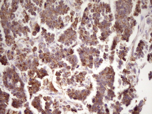 IHC of paraffin-embedded Adenocarcinoma of Human ovary tissue using anti-LRRC6 mouse monoclonal antibody. (Heat-induced epitope retrieval by 1 mM EDTA in 10mM Tris, pH8.5, 120°C for 3min).