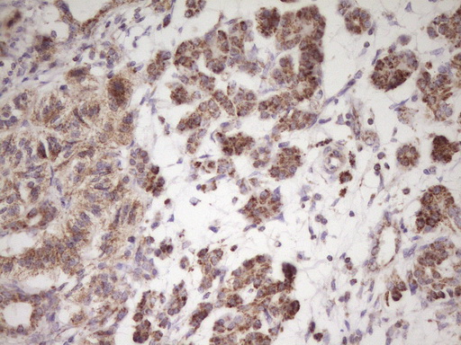 IHC of paraffin-embedded Carcinoma of Human pancreas tissue using anti-LRRC6 mouse monoclonal antibody. (Heat-induced epitope retrieval by 1 mM EDTA in 10mM Tris, pH8.5, 120°C for 3min).