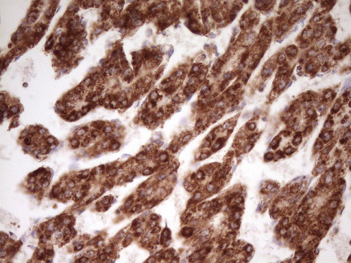 IHC of paraffin-embedded Carcinoma of Human liver tissue using anti-LRRC6 mouse monoclonal antibody. (Heat-induced epitope retrieval by 1 mM EDTA in 10mM Tris, pH8.5, 120°C for 3min).