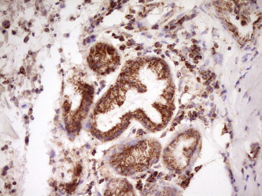IHC of paraffin-embedded Carcinoma of Human lung tissue using anti-LRRC6 mouse monoclonal antibody. (Heat-induced epitope retrieval by 1 mM EDTA in 10mM Tris, pH8.5, 120°C for 3min).