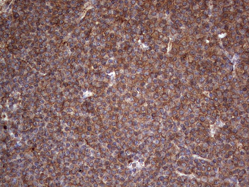 IHC of paraffin-embedded Human lymphoma tissue using anti-LRRTM1 mouse monoclonal antibody. (Heat-induced epitope retrieval by 1 mM EDTA in 10mM Tris, pH8.5, 120°C for 3min).