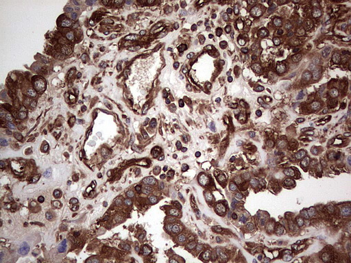 IHC of paraffin-embedded Adenocarcinoma of Human ovary tissue using anti-LRRTM1 mouse monoclonal antibody. (Heat-induced epitope retrieval by 1 mM EDTA in 10mM Tris, pH8.5, 120°C for 3min).