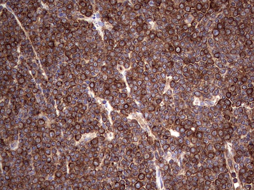 IHC of paraffin-embedded Human lymphoma tissue using anti-LRRTM1 mouse monoclonal antibody. (Heat-induced epitope retrieval by 1 mM EDTA in 10mM Tris, pH8.5, 120°C for 3min).