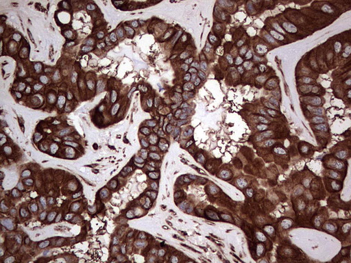 IHC of paraffin-embedded Carcinoma of Human liver tissue using anti-LRRTM1 mouse monoclonal antibody. (Heat-induced epitope retrieval by 1 mM EDTA in 10mM Tris, pH8.5, 120°C for 3min).