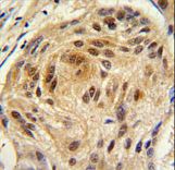Formalin-fixed and paraffin-embedded human lung carcinoma tissue reacted with LSM1 antibody , which was peroxidase-conjugated to the secondary antibody, followed by DAB staining. This data demonstrates the use of this antibody for immunohistochemistry; clinical relevance has not been evaluated.