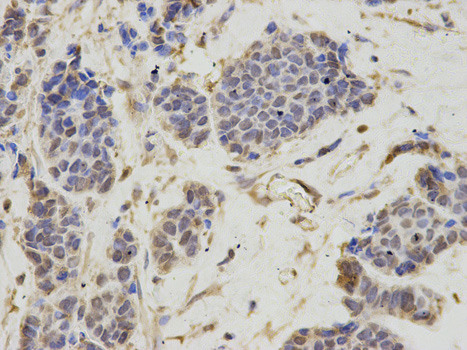Immunohistochemistry of paraffin-embedded human breast cancer using LTA4H antibody at dilution of 1:100 (400x lens).