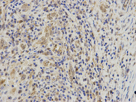 Immunohistochemistry of paraffin-embedded human liver cancer using LTA4H antibody at dilution of 1:100 (400x lens).