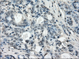 IHC of paraffin-embedded Adenocarcinoma of colon tissue using anti-LTA4H mouse monoclonal antibody. (Dilution 1:50).