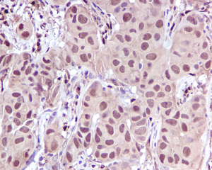 IHC of paraffin-embedded human breast carcinoma tissue using anti-LTA4H antibody.