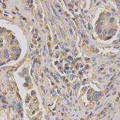 Immunohistochemistry of paraffin-embedded human stomach cancer using LTBR antibody at dilution of 1:200 (x400 lens)
