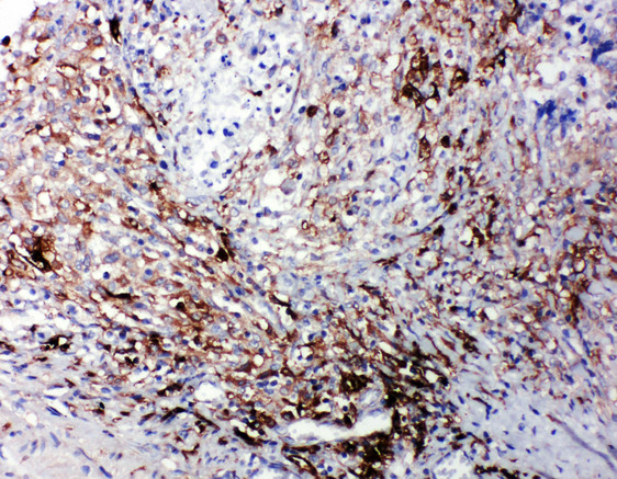 LTBR antibody. IHC(P): Human Intestinal Cancer Tissue.
