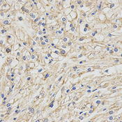 Immunohistochemistry of paraffin-embedded human kidney cancer using LTBR antibody at dilution of 1:200 (x400 lens)