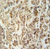 LUZP4 antibody immunohistochemistry of formalin-fixed and paraffin-embedded human testis carcinoma followed by peroxidase-conjugated secondary antibody and DAB staining.