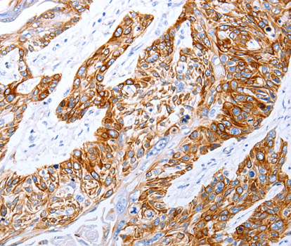 Immunohistochemistry of paraffin-embedded human esophagus cancer tissue using GRPR antibody.