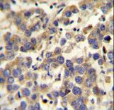 LYPD4 antibody immunohistochemistry of formalin-fixed and paraffin-embedded human testis carcinoma followed by peroxidase-conjugated secondary antibody and DAB staining.