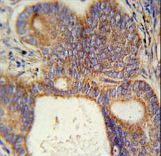 LYSMD1 Antibody immunohistochemistry of formalin-fixed and paraffin-embedded human prostate carcinoma followed by peroxidase-conjugated secondary antibody and DAB staining.