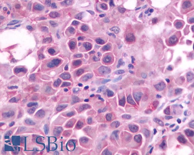 Anti-GRPR antibody IHC of human Skin, Melanoma. Immunohistochemistry of formalin-fixed, paraffin-embedded tissue after heat-induced antigen retrieval.