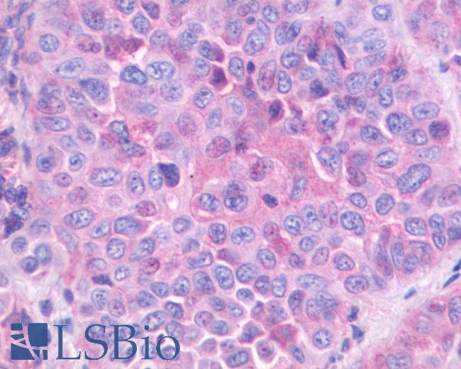 Anti-GRPR antibody IHC of human Lung, Non-Small Cell Carcinoma. Immunohistochemistry of formalin-fixed, paraffin-embedded tissue after heat-induced antigen retrieval.