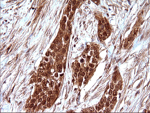 IHC of paraffin-embedded Carcinoma of Human bladder tissue using anti-LZIC mouse monoclonal antibody. (Heat-induced epitope retrieval by 10mM citric buffer, pH6.0, 120°C for 3min).