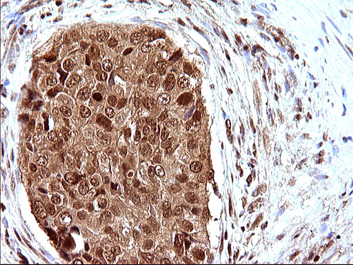 IHC of paraffin-embedded Carcinoma of Human prostate tissue using anti-LZIC mouse monoclonal antibody. (Heat-induced epitope retrieval by 10mM citric buffer, pH6.0, 120°C for 3min).