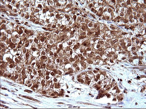 IHC of paraffin-embedded Carcinoma of Human liver tissue using anti-LZIC mouse monoclonal antibody. (Heat-induced epitope retrieval by 10mM citric buffer, pH6.0, 120°C for 3min).