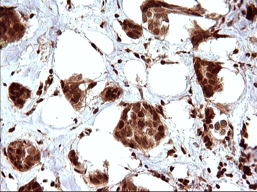 IHC of paraffin-embedded Adenocarcinoma of Human breast tissue using anti-LZIC mouse monoclonal antibody. (Heat-induced epitope retrieval by 10mM citric buffer, pH6.0, 120°C for 3min).