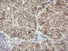 IHC of paraffin-embedded Adenocarcinoma of Human ovary tissue using anti-LZIC mouse monoclonal antibody. (Heat-induced epitope retrieval by 10mM citric buffer, pH6.0, 120°C for 3min).