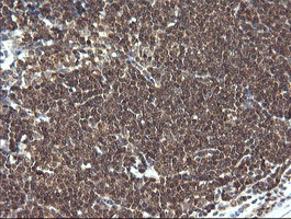IHC of paraffin-embedded Human lymphoma tissue using anti-LZIC mouse monoclonal antibody.