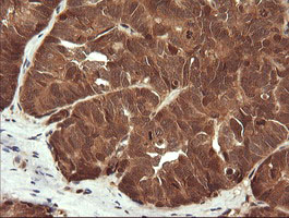 IHC of paraffin-embedded Adenocarcinoma of Human ovary tissue using anti-LZIC mouse monoclonal antibody.