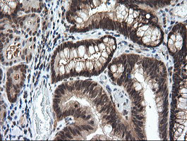 IHC of paraffin-embedded Adenocarcinoma of Human colon tissue using anti-LZIC mouse monoclonal antibody.