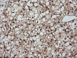 IHC of paraffin-embedded Carcinoma of Human kidney tissue using anti-LZIC mouse monoclonal antibody.
