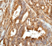 IHC of paraffin-embedded human stomach carcinoma using anti-GOS-28 antibody.