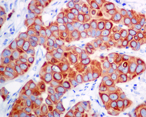 IHC of paraffin-embedded human breast carcinoma tissue using anti-Leukotriene B4 Receptor antibody.