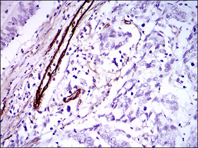 IHC of paraffin-embedded colon cancer tissues using GSC mouse monoclonal antibody with DAB staining.