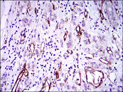 IHC of paraffin-embedded liver cancer tissues using GSC mouse monoclonal antibody with DAB staining.
