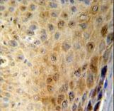 GSDMA Antibody IHC of formalin-fixed and paraffin-embedded human skin carcinoma followed by peroxidase-conjugated secondary antibody and DAB staining.