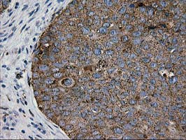 IHC of paraffin-embedded Carcinoma of Human bladder tissue using anti-LGALS3BP mouse monoclonal antibody.