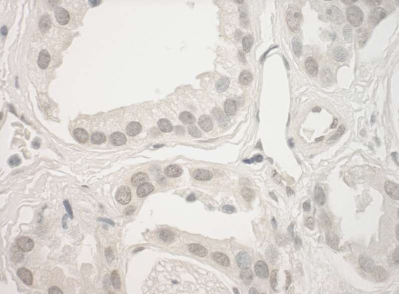 Detection of Human Haspin by Immunohistochemistry. Sample: FFPE section of human prostate carcinoma. Antibody: Affinity purified rabbit anti-Haspin used at a dilution of 1:250.