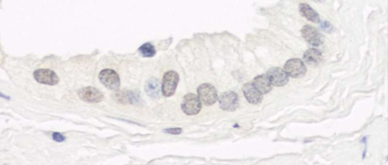 Detection of Human Haspin by Immunohistochemistry. Sample: FFPE section of human prostate carcinoma. Antibody: Affinity purified rabbit anti-Haspin used at a dilution of 1:200 (1 Detection: DAB.