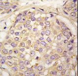 Formalin-fixed and paraffin-embedded human breast carcinoma tissue reacted with MAGEA4 antibody , which was peroxidase-conjugated to the secondary antibody, followed by DAB staining. This data demonstrates the use of this antibody for immunohistochemistry; clinical relevance has not been evaluated.