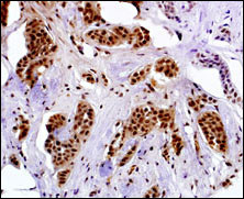 Immunostaining of paraformaldehyde-fixed and paraffin-embedded human breast carcinoma with MAGE-A4 antibody (1:50 dilution), followed by reacting with biotin-conjugated secondary antibody, ABC solution and developing with DAB. Cancerous cells show nuclear staining of MAGE-A4. Magnification: 40X. Data courtesy of Dr. Mi Hou, Karolinska?Institutet and University Hospital, Sweden.