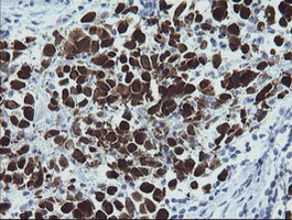 IHC of paraffin-embedded Carcinoma of Human bladder tissue using anti-MAGEA4 mouse monoclonal antibody. (Heat-induced epitope retrieval by 10mM citric buffer, pH6.0, 120°C for 3min).