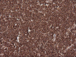 IHC of paraffin-embedded Human lymphoma tissue using anti-MAGEA4 mouse monoclonal antibody.